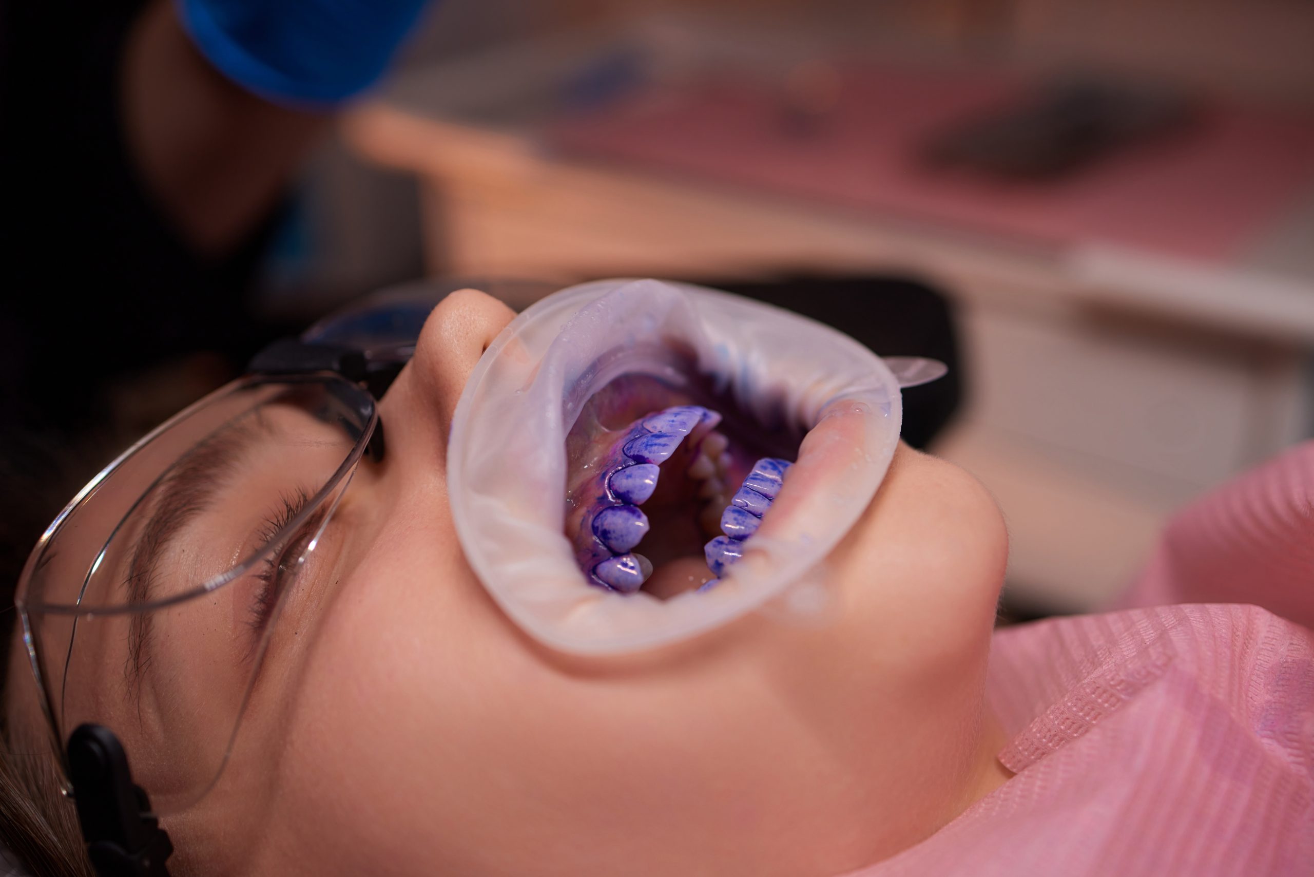 Plaque,Indicator,On,Human,Teeth,With,Braces.,Plaque,Is,Colored